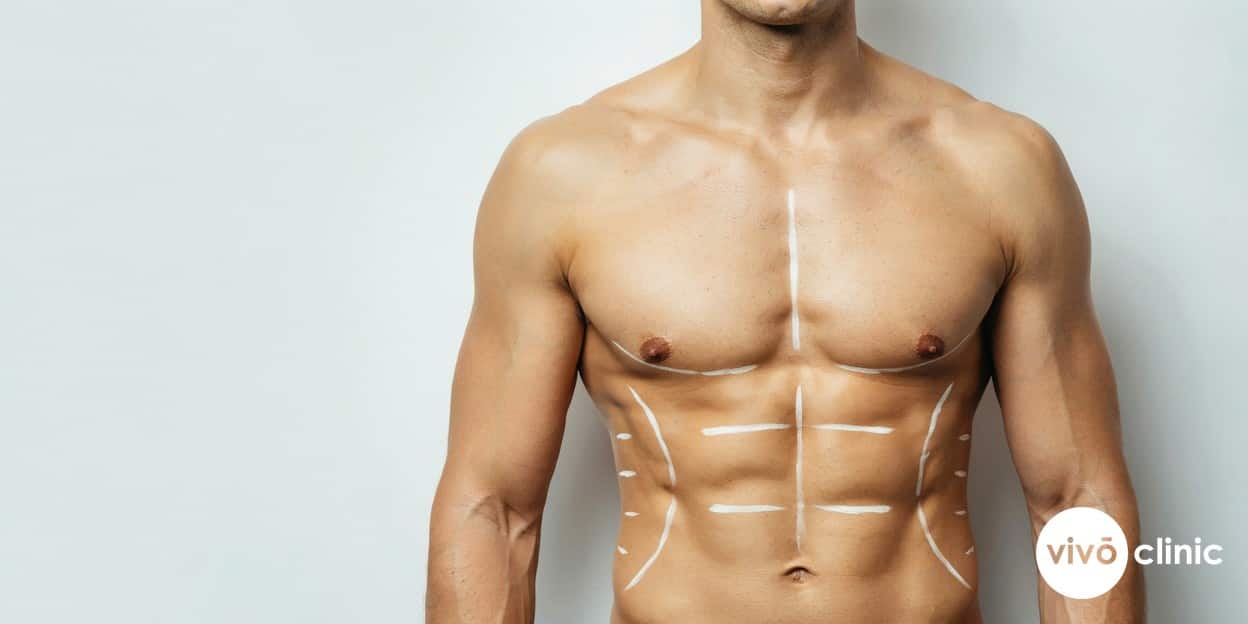 Middle Eastern man’s torso marked with white cosmetic guide lines across the abdomen and flanks ahead of body contouring at VIVO Clinic Dubai