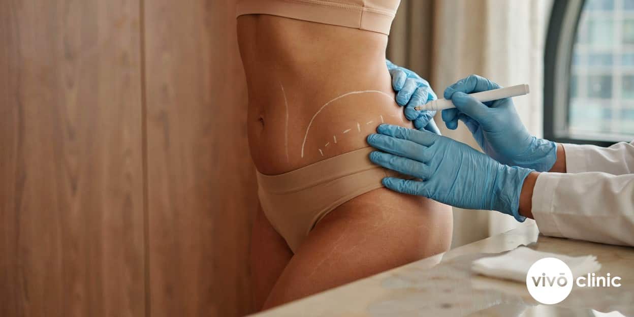 Practitioner’s gloved hands marking white cosmetic contour lines on a Middle Eastern woman’s flank in a premium Dubai clinic, planning the sequence of a fat freezing and cavitation protocol, no device, machine or handpiece anywhere in frame