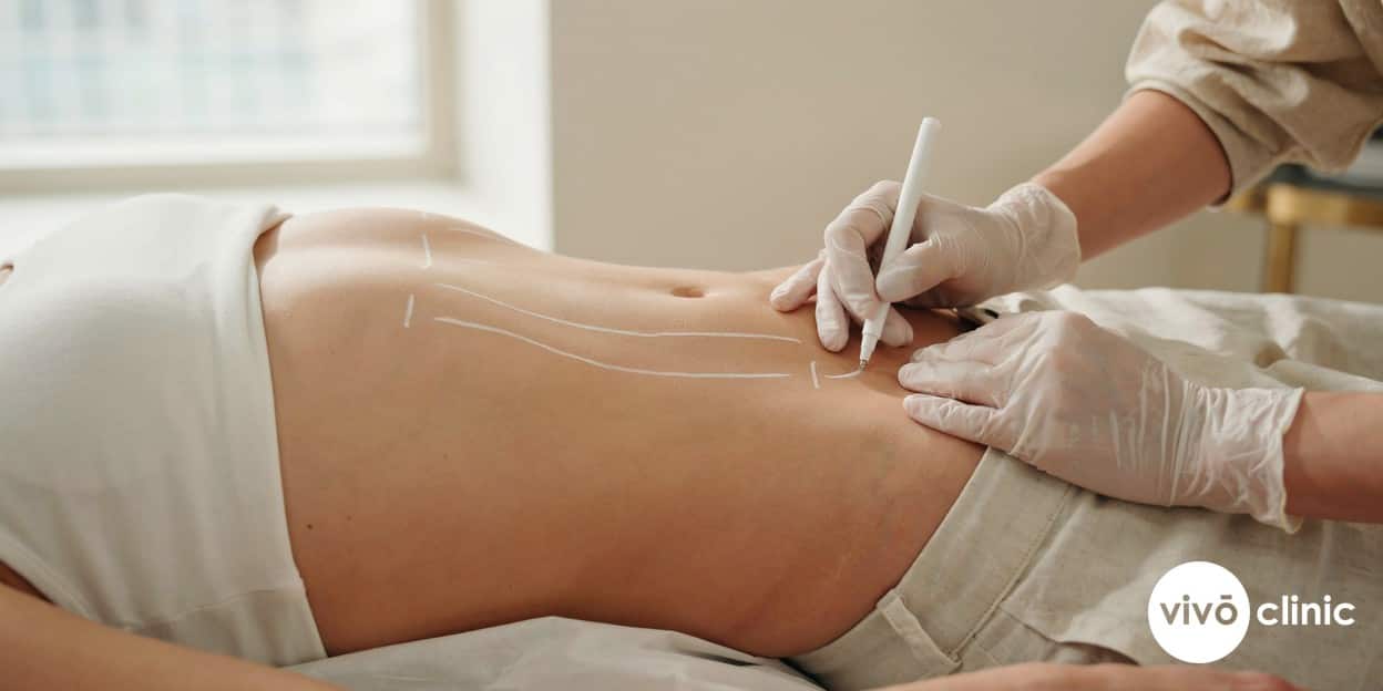 Close-up of a practitioner’s gloved hands drawing white cosmetic marking lines on a Middle Eastern woman’s abdomen before a fat freezing treatment, no device, machine or handpiece anywhere in frame