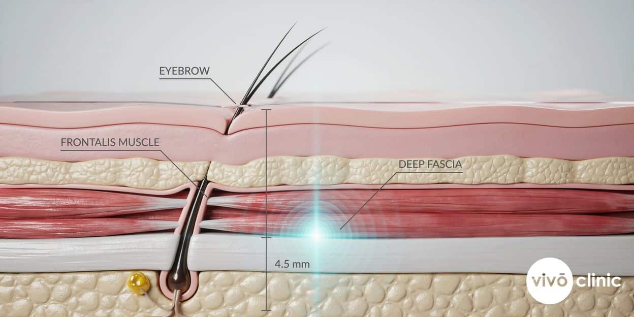 Photorealistic anatomical cross-section render of the lateral brow showing the HIFU focal point reaching the deep fascia at 4.5mm depth, with the eyebrow, forehead muscle and upper eyelid skin labelled to illustrate non-surgical brow elevation