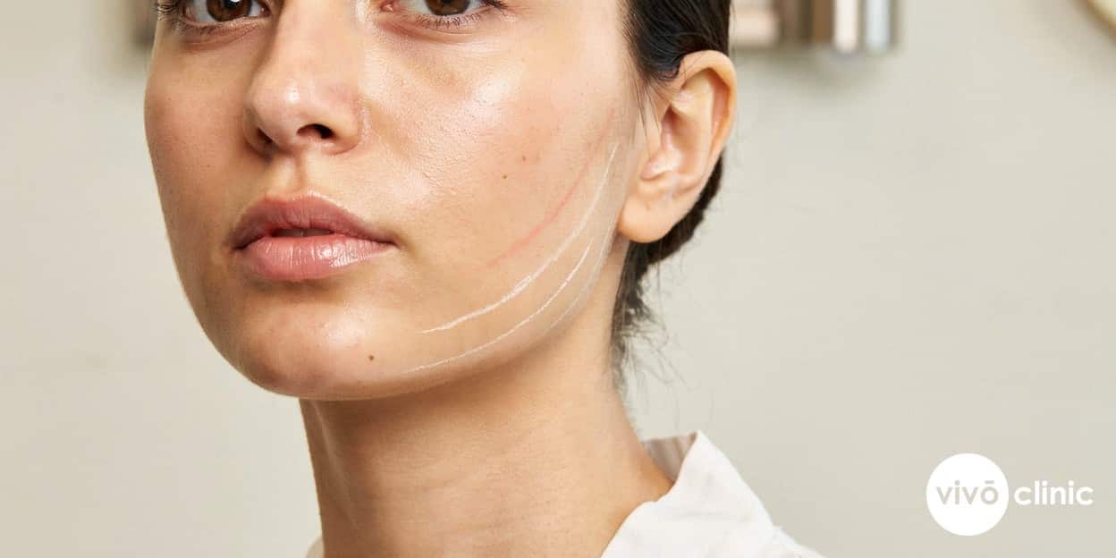 Close-up of a Middle Eastern woman’s lower face showing mild, expected redness along the jawline after a HIFU facelift session, an example of a common transient side effect