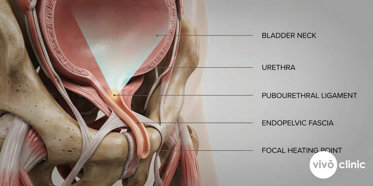 Photorealistic anatomical cross-section render of the female pelvic floor showing the urethra, pubourethral ligament and endopelvic fascia, with focused ultrasound energy heating the supportive tissue layer