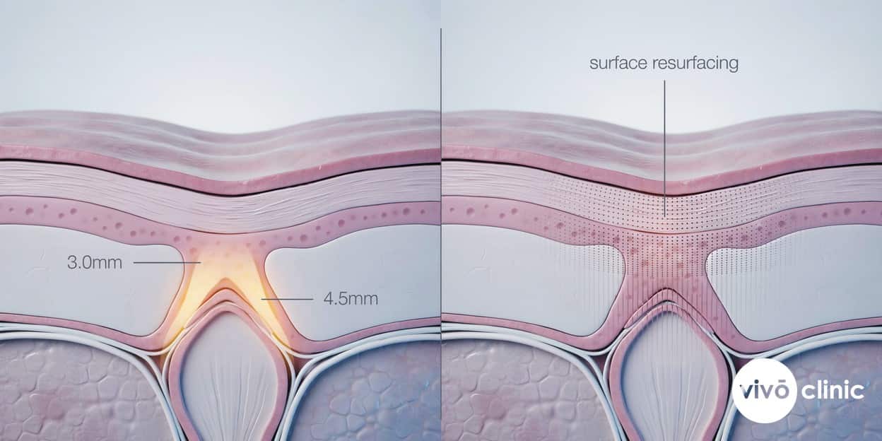 Photorealistic cross-section render comparing non-ablative HIFU focal heating zones at 3.0mm and 4.5mm tissue depth against fractional laser micro-channels resurfacing the mucosal surface
