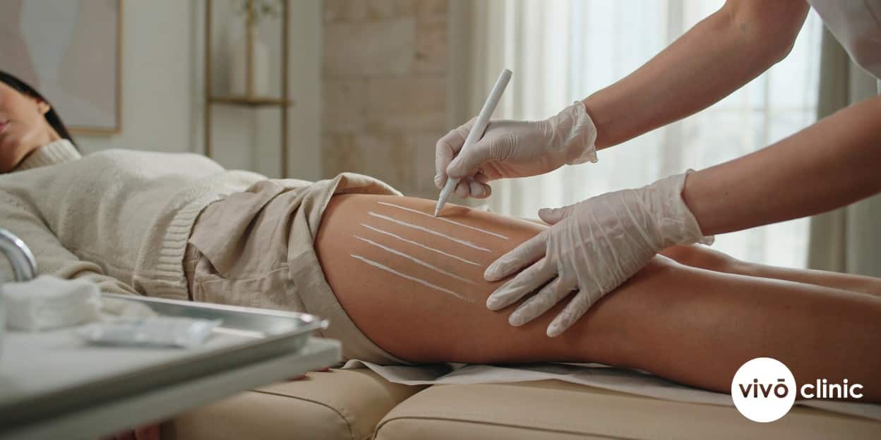 Practitioner in modest attire using white cosmetic marking pen to map treatment zones on a Middle Eastern woman’s thigh before roller vacuum RF cellulite treatment at VIVO Clinic Dubai, no device or handpiece in frame