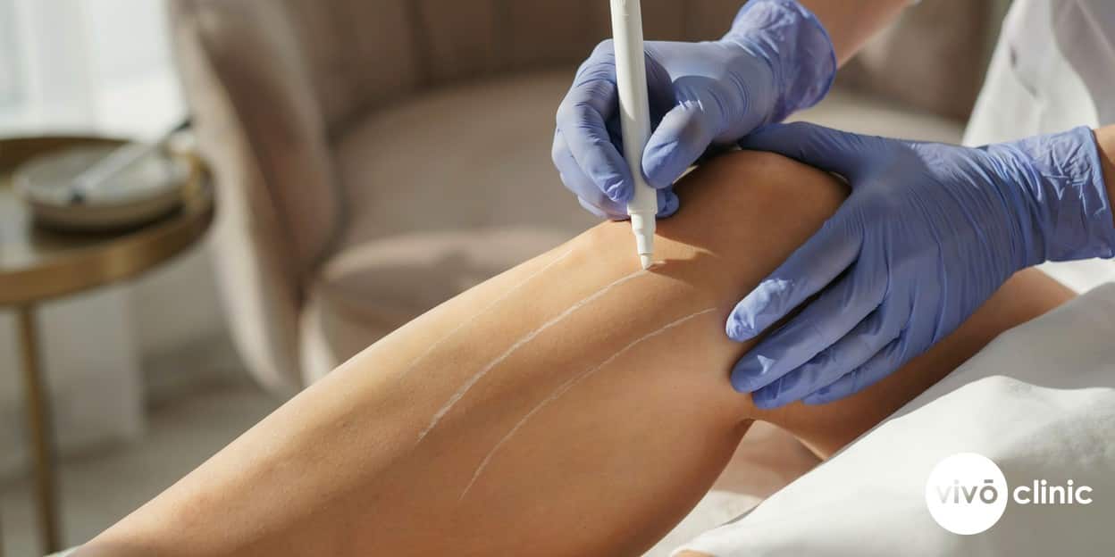 Photorealistic close-up of a practitioner’s gloved hands marking white assessment guide lines on the back of a thigh to plan a cellulite reduction course, no device, machine or handpiece anywhere in frame