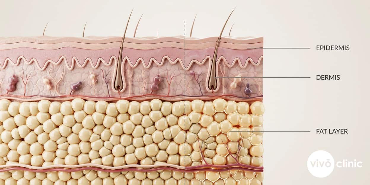 Photorealistic technical cross-section render of skin and the subcutaneous fat layer showing how a single cryolipolysis cycle reduces fat-cell density, with embedded depth labels for epidermis, dermis and fat layer