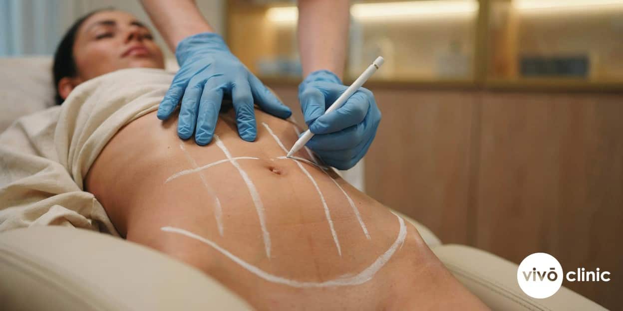 Practitioner’s gloved hands drawing white assessment-mapping lines across a Middle Eastern woman’s abdomen while planning the number of fat freezing cycles at VIVO Clinic Dubai