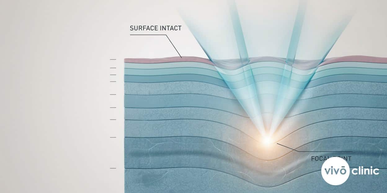 Photorealistic technical cross-section render of vaginal wall tissue showing focused ultrasound energy converging at a deep focal point below an intact, undamaged mucosal surface, illustrating the non-ablative mechanism of HIFU