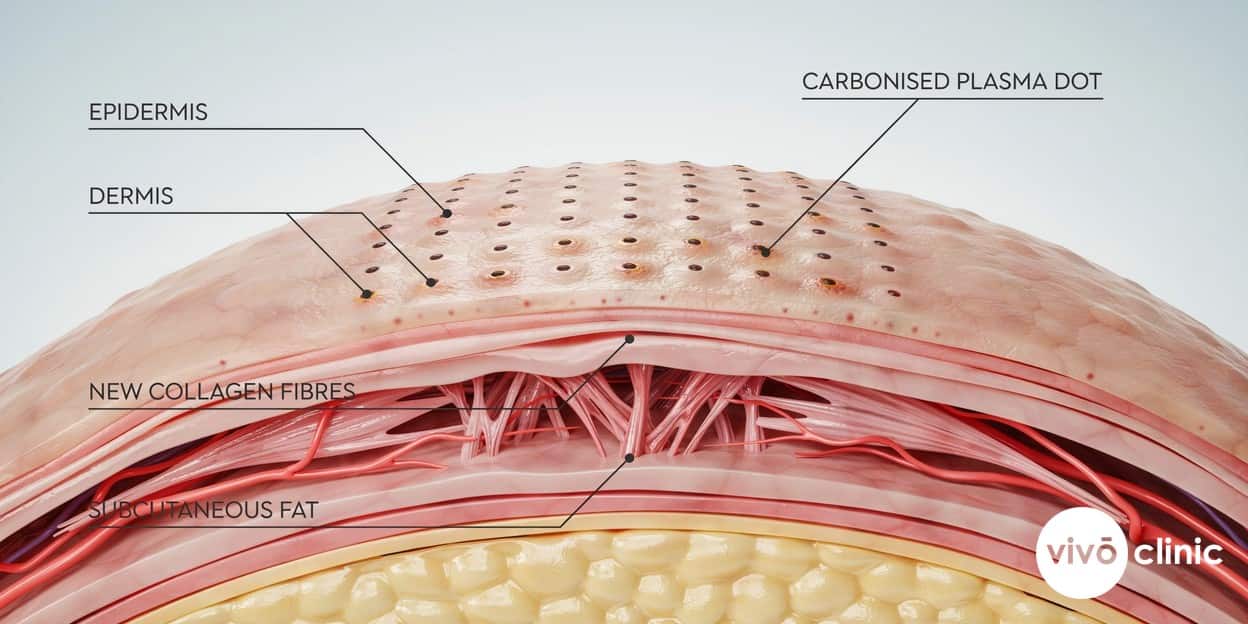Photorealistic technical cross-section render of eyelid skin showing a grid of small carbonised plasma treatment dots on the surface with new collagen fibres forming in the dermis below, labelled by depth
