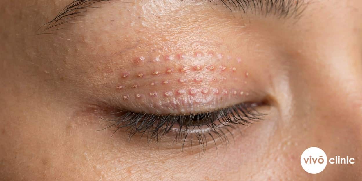 Photorealistic close-up of a grid of small healing dots along an upper eyelid showing normal scabbing and mild redness during recovery from a plasma eye lift, with a clinical, reassuring tone