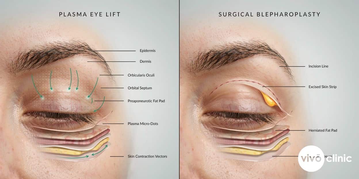 Photorealistic clinical cross-section render of a hooded upper eyelid comparing a plasma eye lift’s surface micro-dots and skin contraction against a surgical blepharoplasty incision removing a strip of excess skin and fat