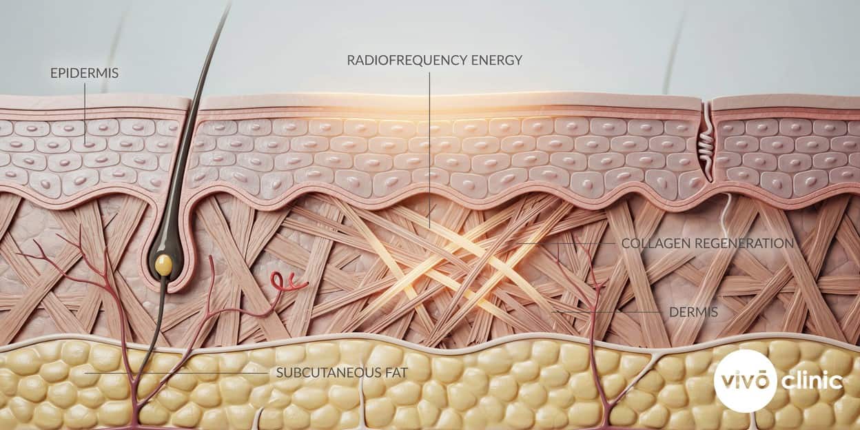 Photorealistic technical cross-section render of body skin showing radiofrequency energy heating the dermis layer with new collagen fibres forming beneath the surface, illustrating how RF tightens loose skin on the body