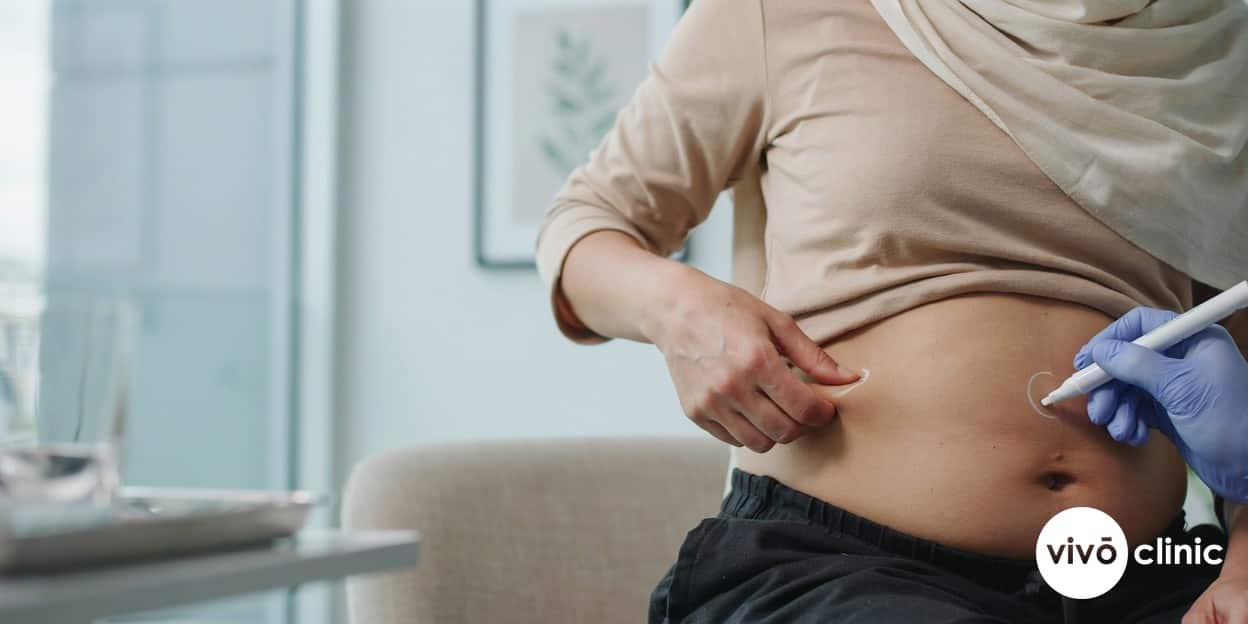 Middle Eastern woman in modest clothing pinching a small area of abdominal fat while a gloved practitioner marks it with white cosmetic lines at VIVO Clinic Dubai