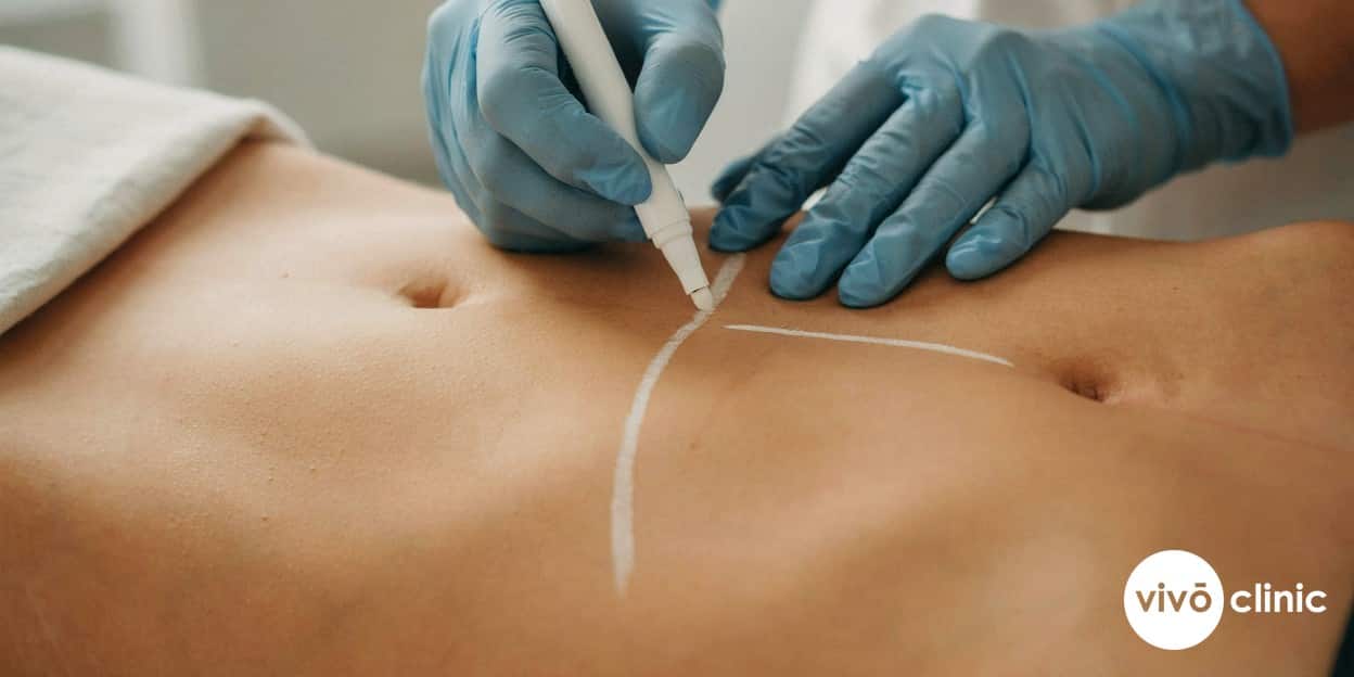 Close-up of a gloved Middle Eastern practitioner’s hands drawing white cosmetic marking lines on a client’s abdomen during a pre-treatment safety assessment, modest clinical setting, no device, machine or handpiece anywhere in frame