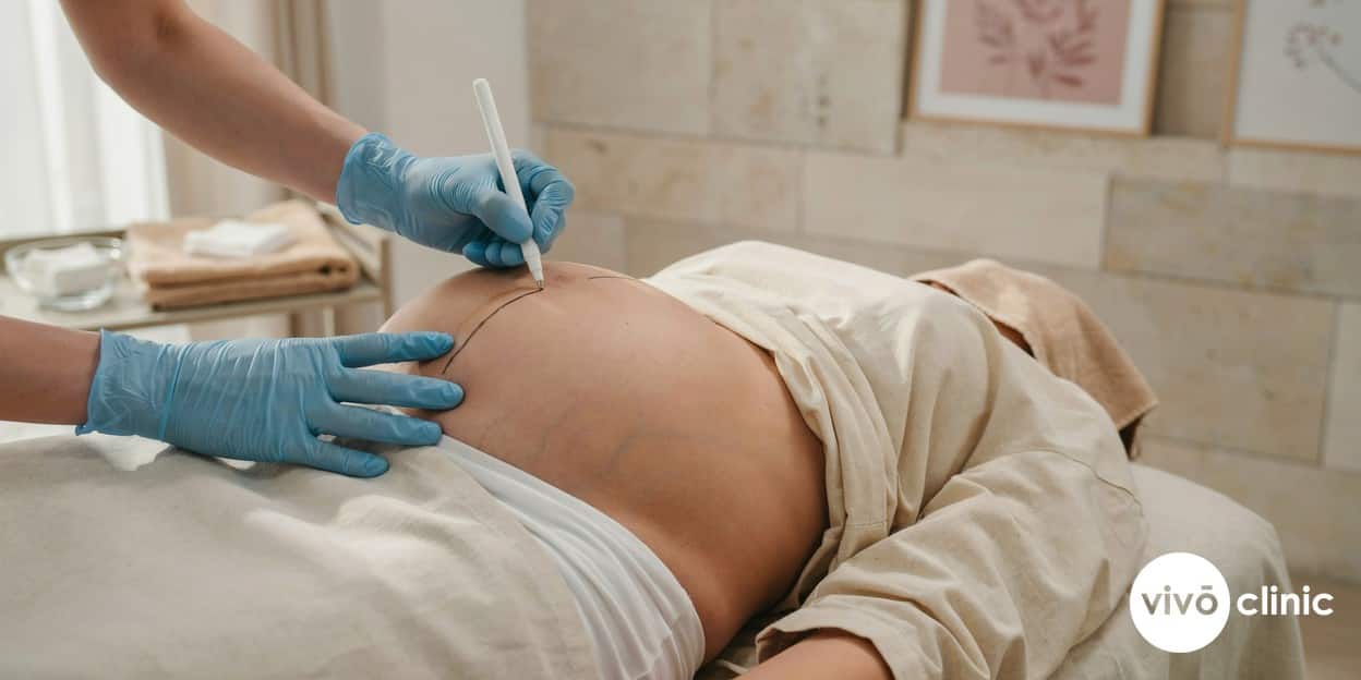 Practitioner’s gloved hands drawing white cosmetic marking lines on a Middle Eastern woman’s abdomen during a post-pregnancy body assessment at VIVO Clinic Dubai