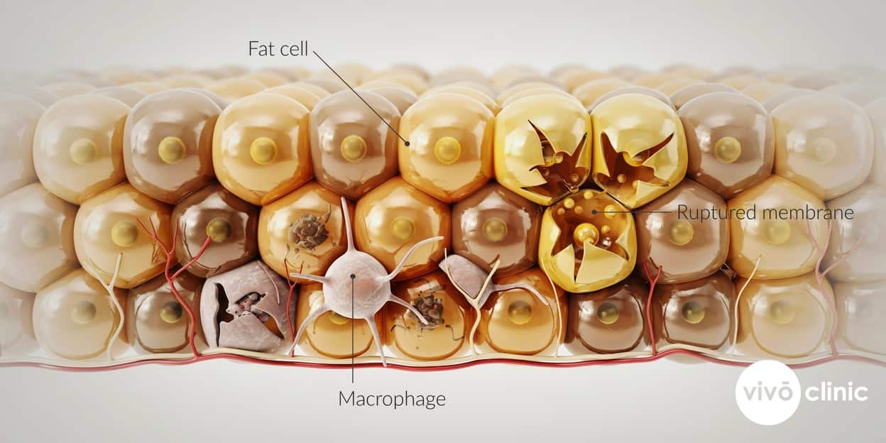 Photorealistic technical cross-section render of subcutaneous fat showing sodium deoxycholate rupturing adipocyte membranes and macrophages clearing fat-cell debris, with clean embedded labels for fat cell, ruptured membrane and macrophage