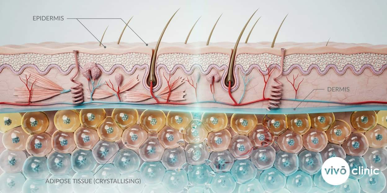 Photorealistic cross-section render of skin layers showing crystallising fat cells in the deep adipose layer beneath an unharmed epidermis and dermis during cryolipolysis, with depth labels