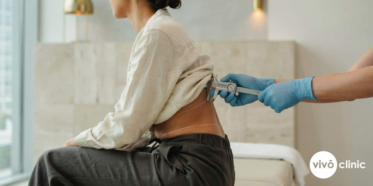 Practitioner’s gloved hands holding a caliper to measure the fat layer on a Middle Eastern woman’s flank, marked with white cosmetic lines, at VIVO Clinic Dubai