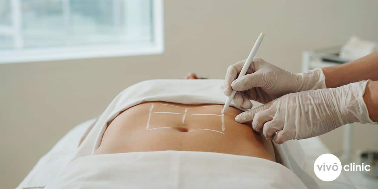 Practitioner in modest attire drawing white cosmetic marking lines on a Middle Eastern woman’s abdomen to map a measured ultrasound cavitation treatment area, with no device anywhere in frame