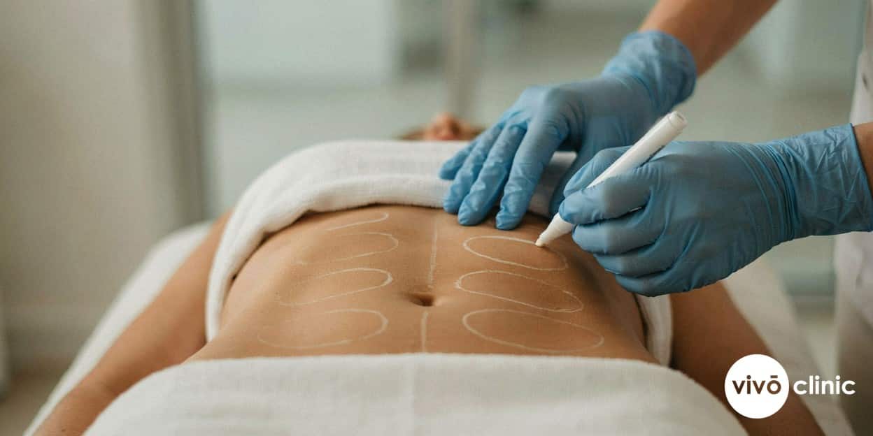 Practitioner’s gloved hands drawing white cosmetic marking lines on a Middle Eastern woman’s abdomen to plan a combined cavitation and radiofrequency body session at VIVO Clinic Dubai