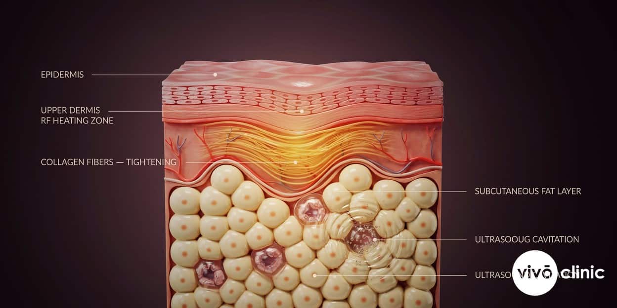 Photorealistic technical cross-section render of skin and subcutaneous fat showing how ultrasound cavitation disrupts fat cells in the deeper layer while radiofrequency heats and tightens the upper dermis, illustrating why the two combine in one body session